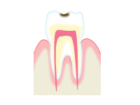 虫歯の進行