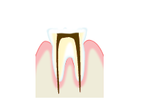 虫歯の進行